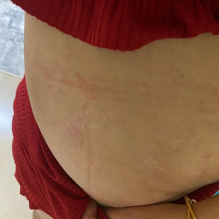 Lohusa Korsesi Kullanımında Yaşanan Rahatsızlık Ve İade Süreci Sorunu