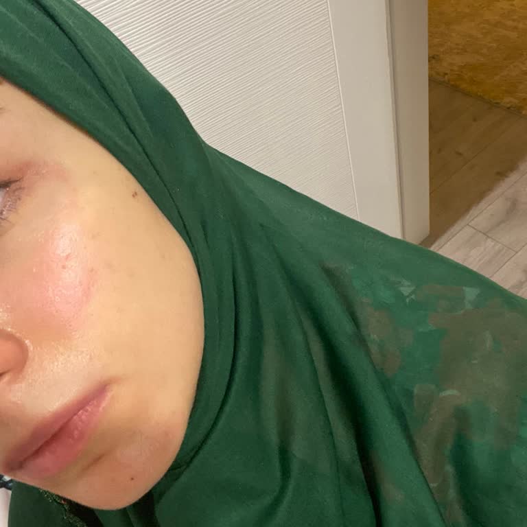 Watsons Organik Makyaj Temizleme Suyu Cildimde Kızarıklığa Sebep Oldu