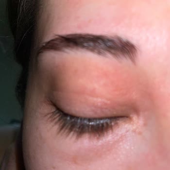 Göz Kapağımda Yanık Ve Pul Pul Dökülme Oluştu!