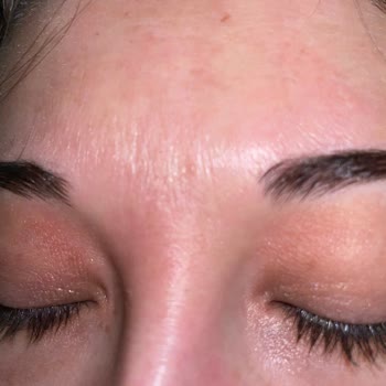 Göz Kapağımda Yanık Ve Pul Pul Dökülme Oluştu!