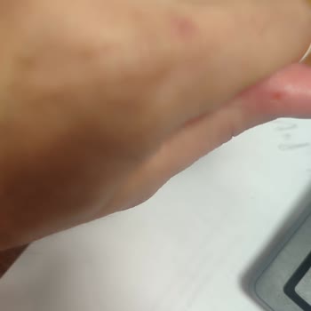 Şok Marketler Lavabo Açıcı Kimyasal Tepkimesi Sonucu Ciddi Hasar Ve Yaralanma!