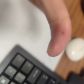 Mintax Lavabo Açıcı Patlaması Sonucu Ciddi Hasar Ve Kimyasal Yanık