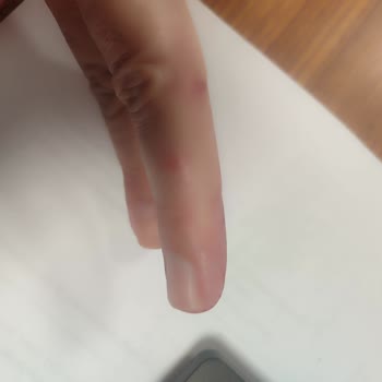 Mintax Lavabo Açıcı Patlaması Sonucu Ciddi Hasar Ve Kimyasal Yanık