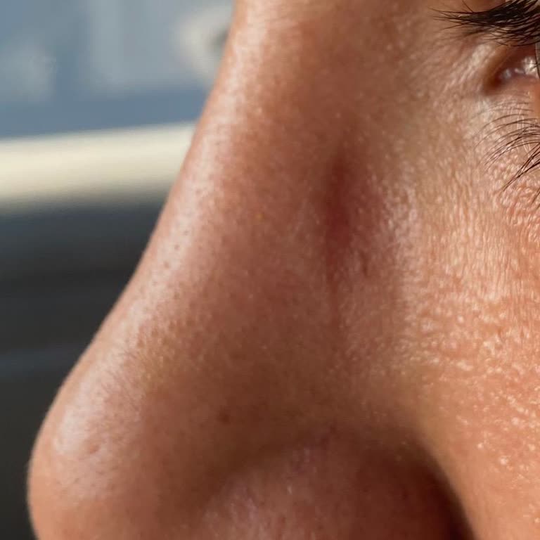 Rayban Gözlük Burun Bölgesinde Ağrı Ve Morarma Yaratıyor, Değişim Talebim Reddedildi