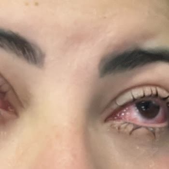 Neslim Güngen Güzellik Göz Sağlığımı Tehlikeye Atan Kirpik Lifting İşlemi Ve Sorumluluk Reddi