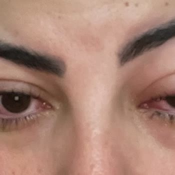 Neslim Güngen Güzellik Göz Sağlığımı Tehlikeye Atan Kirpik Lifting İşlemi Ve Sorumluluk Reddi