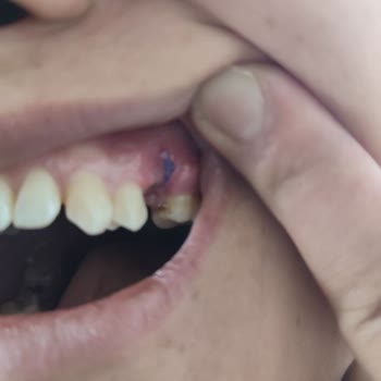 Diş Tedavisinde Yapılan Hatalar Ve İlgisiz Doktor