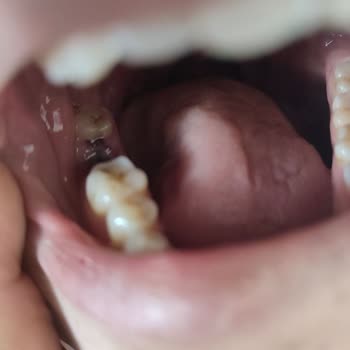 Diş Tedavisinde Yapılan Hatalar Ve İlgisiz Doktor