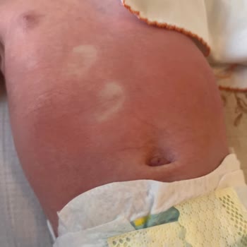 La Roche Posay Lipikar Serie löst schwere Hautreaktion bei 3 Monate altem Baby aus