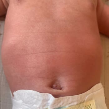 La Roche Posay Lipikar Serie löst schwere Hautreaktion bei 3 Monate altem Baby aus