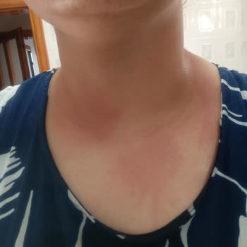 DP Şampuan Durulanmayan Sıvı Saç Kremi Boynumu Yaktı Kaşındırıyor