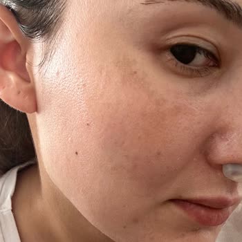 Solante Pigmenta Sonrası Cildimde Lekeler Arttı Ve Kötü Deneyim Yaşadım