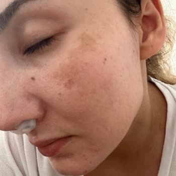 Solante Pigmenta Sonrası Cildimde Lekeler Arttı Ve Kötü Deneyim Yaşadım