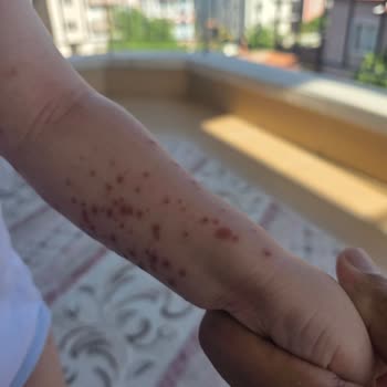 Otel Hijyen Eksiklikleri Ve Yetersiz Temizlik Hizmeti Nedeniyle Yaşanan Sağlık Sorunları