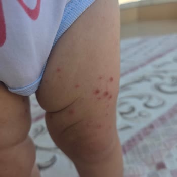 Otel Hijyen Eksiklikleri Ve Yetersiz Temizlik Hizmeti Nedeniyle Yaşanan Sağlık Sorunları