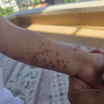 Otel Hijyen Eksiklikleri Ve Yetersiz Temizlik Hizmeti Nedeniyle Yaşanan Sağlık Sorunları