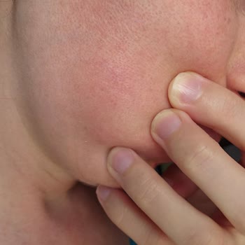 Güneş Kremi Kullanımı Sonrası Ciltte Yanma Sorunu Yaşadım