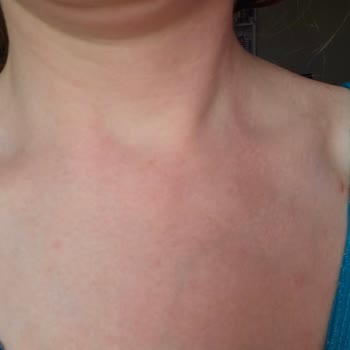 Güneş Kremi Kullanımı Sonrası Ciltte Yanma Sorunu Yaşadım