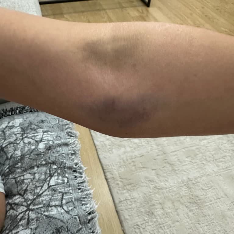 Aynı Hemşirenin Aldığı Kan Sonrası Tekrar Morarma Yaşadım
