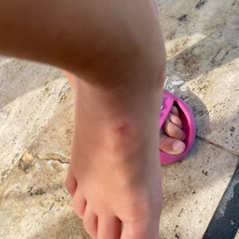 İgor Çocuk Sandaleti Ciddi Yara Ve Tahrişe Neden Oldu Kalite Beklentisini Karşılamadı