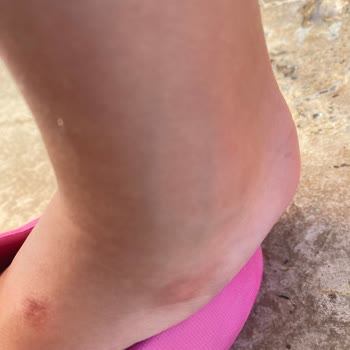 İgor Çocuk Sandaleti Ciddi Yara Ve Tahrişe Neden Oldu Kalite Beklentisini Karşılamadı