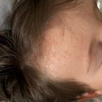 Balık Yağı Sonrası Çocuğumda Alerji Ve Ciddi Cilt Sorunları Yaşandı