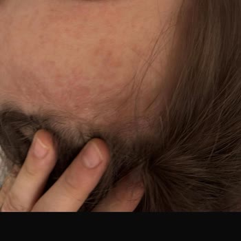 Balık Yağı Sonrası Çocuğumda Alerji Ve Ciddi Cilt Sorunları Yaşandı