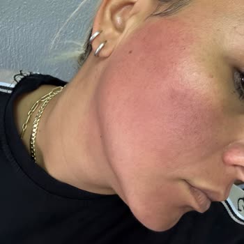 L’Oréal Paris Sonnenschutz brennt stark im Gesicht trotz dermatologischer Prüfung