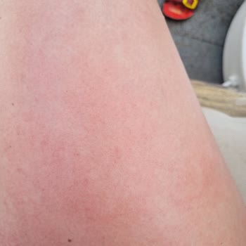 Mustela Sonnencreme SPF 50 verursachte Sonnenallergie und ruinierte meinen Urlaub