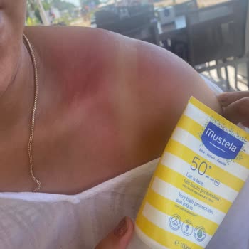 Mustela Sonnencreme schützt nicht vor Sonnenbrand trotz korrekter Anwendung