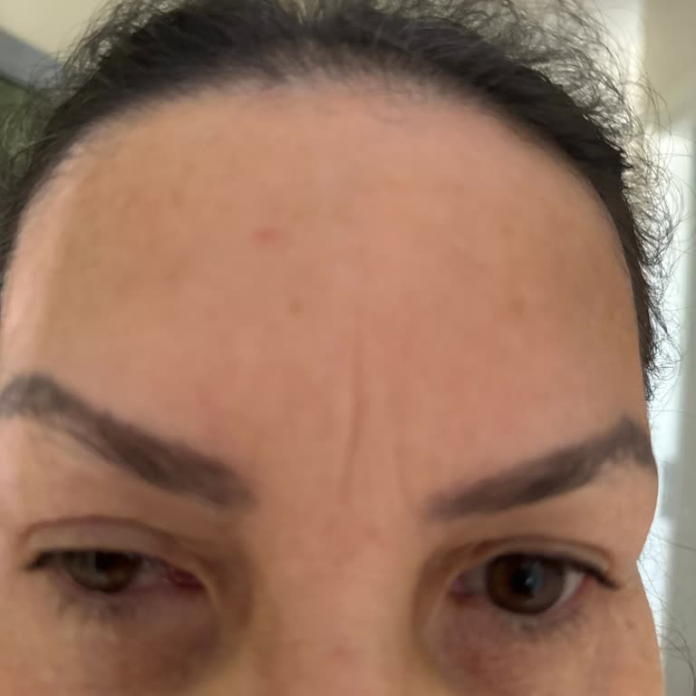 British Esthetic Botoks Sonrası Gözde Sorun ve Yetersiz İlgi