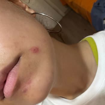 Polosmart Siyah Nokta Temizleyici Cildime Zarar Verdi, İade Ve Geri Ödeme Talebim Var