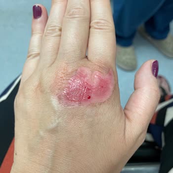 Stanley Termos Patladı Ve Elimi Yaktı: Ciddi Mağduriyet Yaşadım