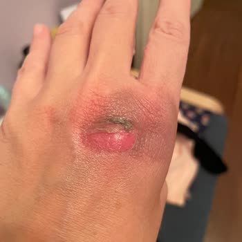 Stanley Termos Patladı Ve Elimi Yaktı: Ciddi Mağduriyet Yaşadım