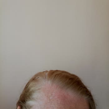 I Face Severe Reaction and Poor Coverage with L'Oréal Paris 01 Ultra Light Blonde Hair Dye