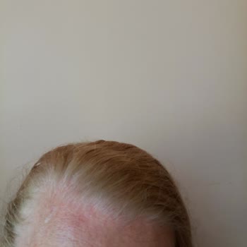 I Face Severe Reaction and Poor Coverage with L'Oréal Paris 01 Ultra Light Blonde Hair Dye