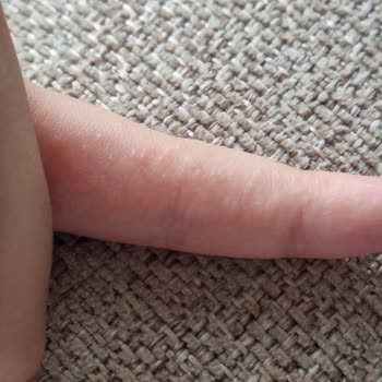 Dalan Sabunları Sonrası Ellerimde Ve Kızımda Egzama Oluştu