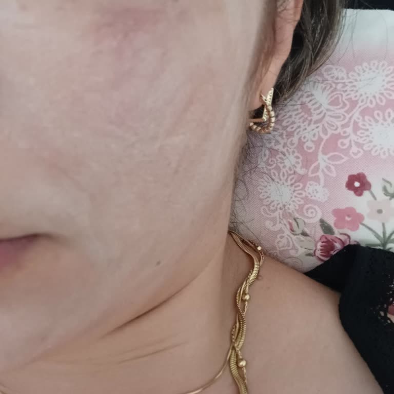 Beklentileri Karşılamayan İşlem Sonrası Artan Cilt Sorunları