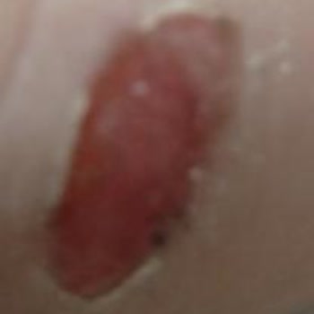 İlk Giyişte Yara Yapan Ayakkabı Ve Mağazadan İade Reddi