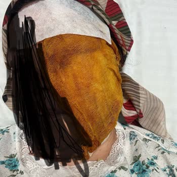 İlgisiz Ve Sorumluluk Almayan Doktor Nedeniyle Zorlu İmplant Tedavisi Süreci