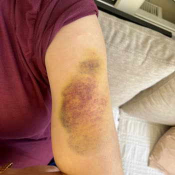 Ameliyat Sonrası Morluklar Ve İlgisiz Personel Şikayeti