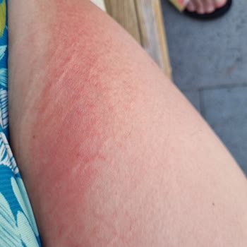 Mustela Crema Solar 50 SPF me causó alergia, solicito reembolso