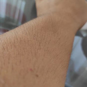 Lazer Epilasyon Sonrası Tüylerim Arttı, Personel Yetersiz Ve İlgisiz