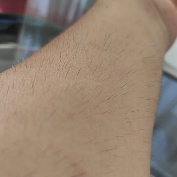 Lazer Epilasyon Sonrası Tüylerim Arttı, Personel Yetersiz Ve İlgisiz