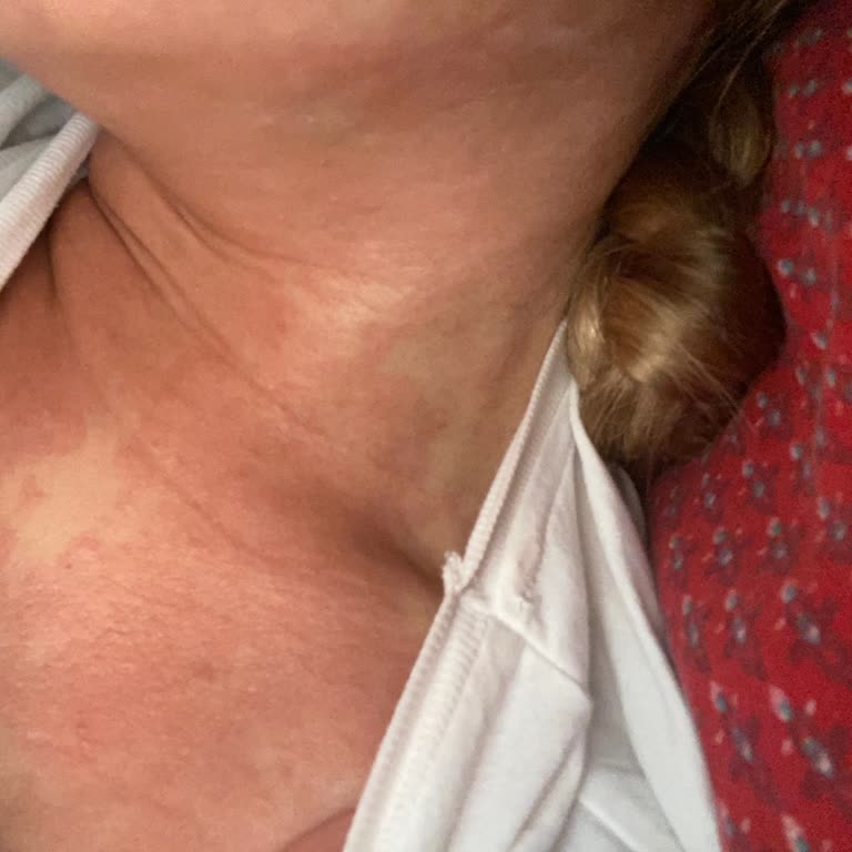 Dermokil Yüz Maskesi Cildimde Alerji Ve Kızarıklık Yaptı, Çözüm Sunulmadı