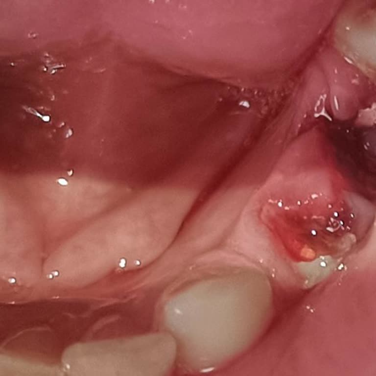 İzmir Eğitim Diş Hastanesi Kanal Tedavisi İçin Gittim Dişim Çekildi Ve Kırık Kaldı