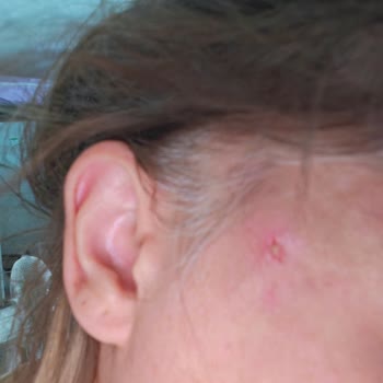 Ruhsatsız Ve Denetimsiz Yerde Yapılan Yüz Germe İşlemi Sonrası Sağlık Sorunları Ve Mağduriyet