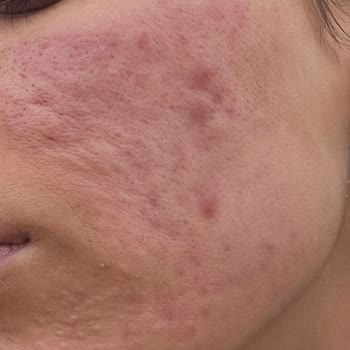 Cilt Bakımı Sonrası Fayda Görmedim, Param Ve Sağlığım Boşa Gitti