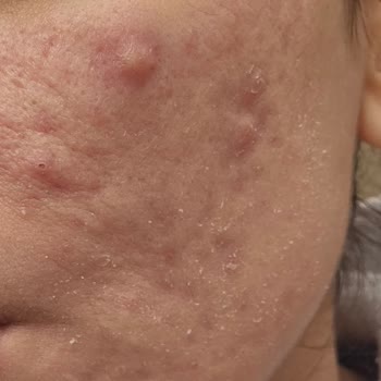 Cilt Bakımı Sonrası Fayda Görmedim, Param Ve Sağlığım Boşa Gitti