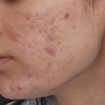 Cilt Bakımı Sonrası Fayda Görmedim, Param Ve Sağlığım Boşa Gitti